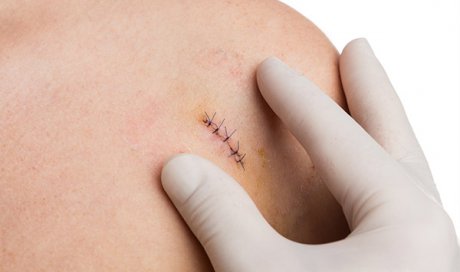 Rendez-vous avec un infirmier pour retirer des points de suture à Bousbecque.